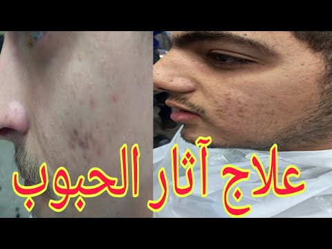 How To Treat Acne And Black Spots