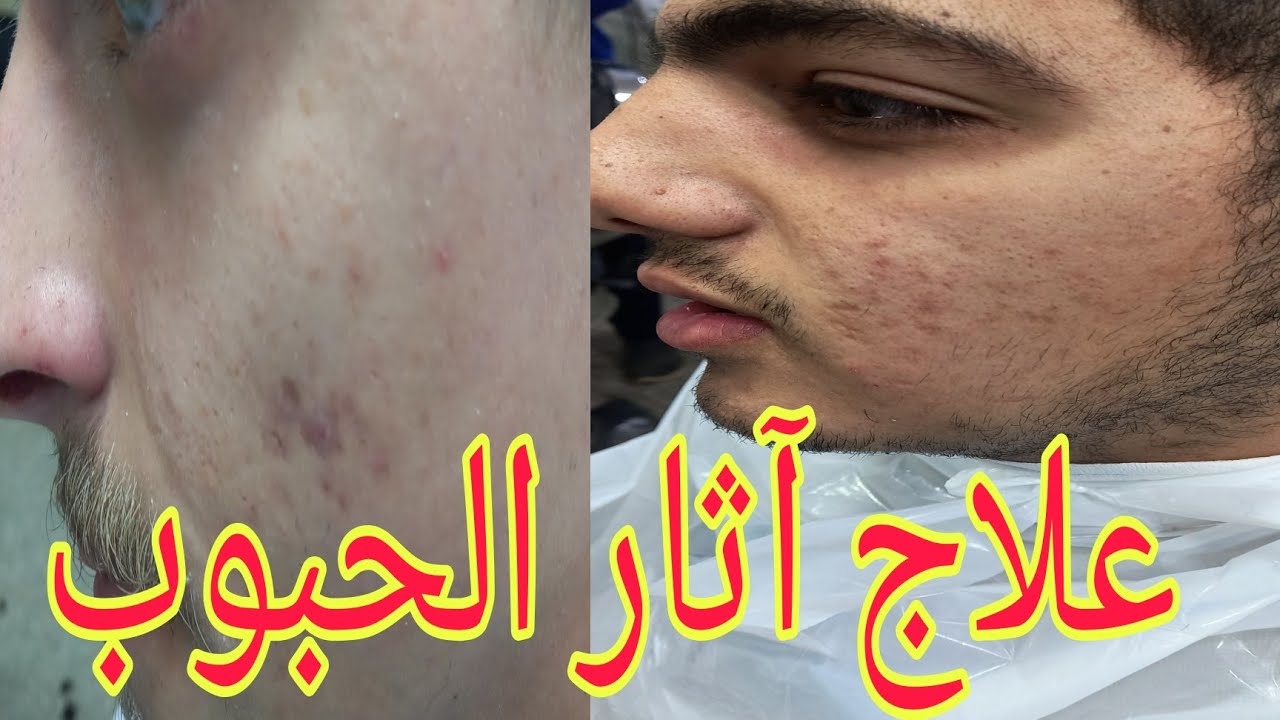 ازاى تعالج آثار الحبوب والبقع السوداء