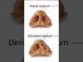 #nasalseptum #deviatedseptum #nose #entsurgeon