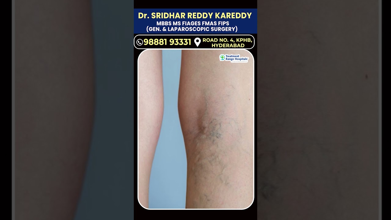 Best Treatment for Varicose Veins with Fast Recovery Results | Treatment Range Hospital 