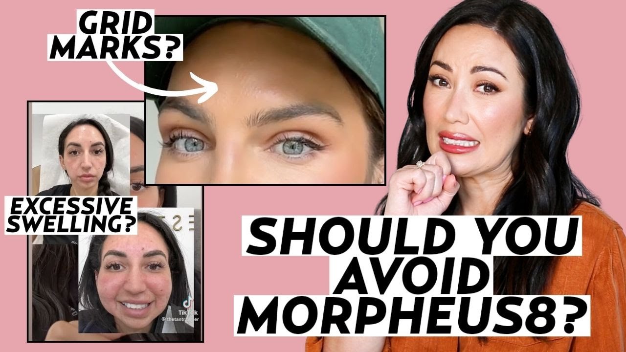 Morpheus8 Treatment: Dermatologists Explain Radiofrequency Microneedling