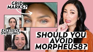 Morpheus8 Treatment: Dermatologists Explain Radiofrequency Microneedling