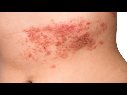 Fabelhafte Ist Eine Grtelrose Gefhrlich Bilder