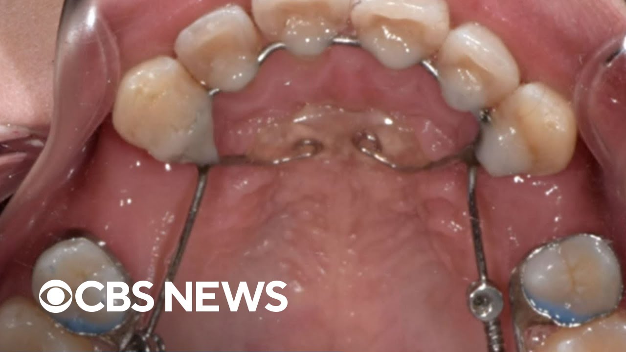 Lawsuit claims dental device damaged patients' teeth