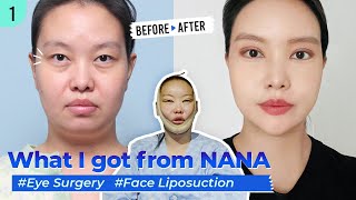 [SUB] Mom of two's journey at Nana Hospital | Face Liposuction, Incisional Double Eyelid and more!