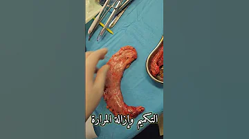 تكميم المعدة وإزالة المرارة 
