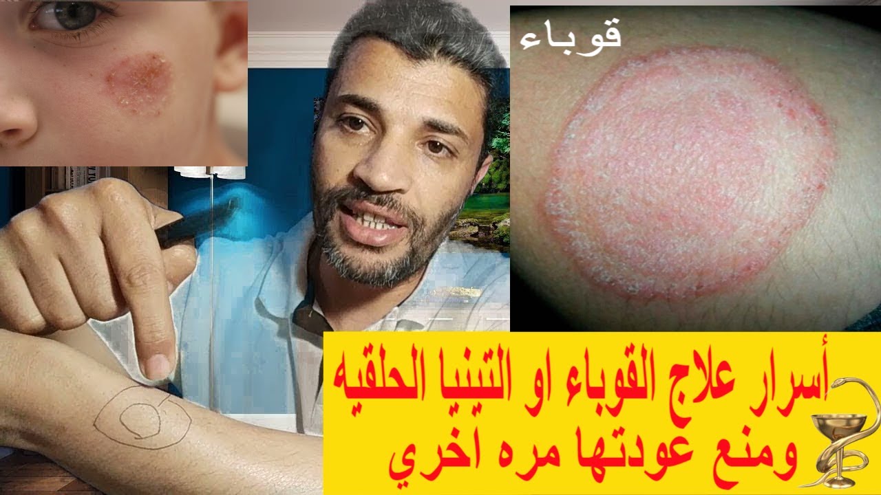 أسرارعلاج القوباء اوالتينيا والفطريات الحلقيه علشان ماترجعش تاني Tinea corporis or circinata
