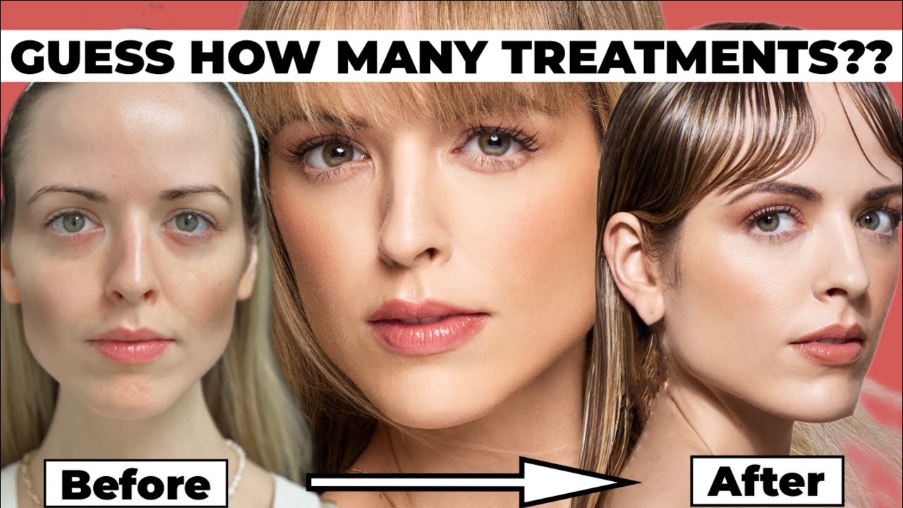 Сколько мне нужно препарата Scultpra? Примеры реальных пациентов!