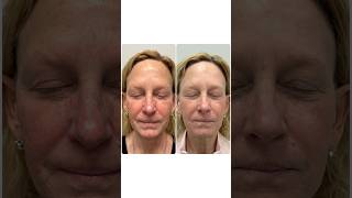 Transform Your Skin With A Fraxel 1927 Series