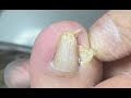 Extremely sharp nail repair