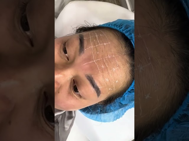 Kỹ thuật xo/á nhă/n trán #viral #lamdep #xuhuong #nguyenbahong #botox #filler #xoanhan #shorts class=