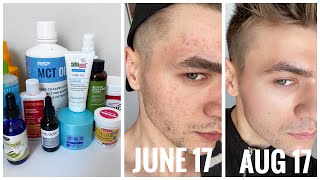 How to treat Fungal Acne | Tiny Little Bumps | How I got rid of my fungal acne | Skincare Routine screenshot 5