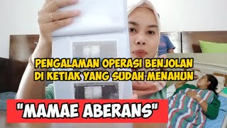 Operasi Benjolan di Ketiak yang sudah Menahun pakai BPJS Gratis || Mamae Aberans