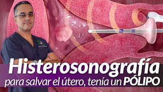 Una Histerosonografía para salvar el útero [Pólipo no diagnosticado en Estados Unidos]