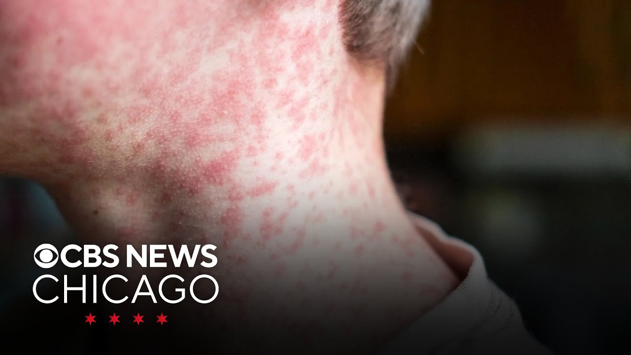 2nd measles case confirmed in suburban Cook County, O'Hare Terminal 5 is point of exposure