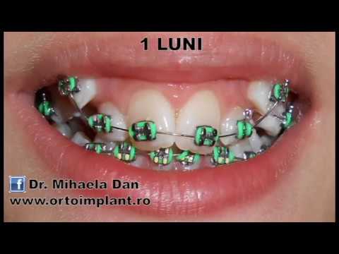 Aparat Dentar Fix - Ortodontie copii