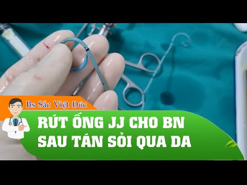 Video RÚT ỐNG JJ CHO BỆNH NHÂN SAU TÁN SỎI QUA DA - Sỏi thận... - youtube