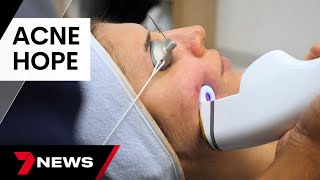 New long term acne treatment promising to clear up skin, but at a cost | 7 News Australia