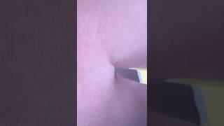 Plucking slivers from my bf’s arm #satisfyingskincare #extraction #sliverremoval #splinterremoval