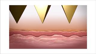 Tixel Eyelid treatment and Skin Rejuvenation at Ace Aesthetics.