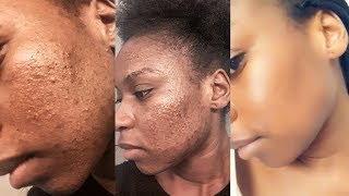 Part 2 Comment Je Me Suis Débarrassée De Mes Boutons Et De Mes Taches? La Seule Solution