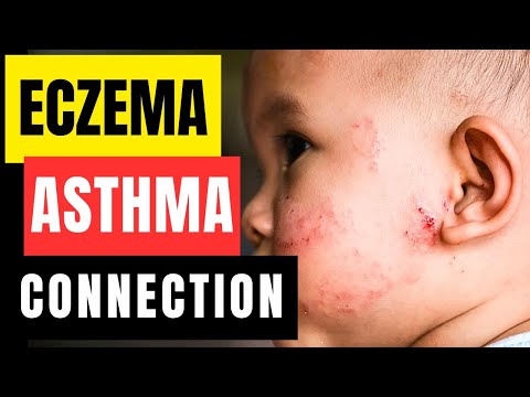 Eczema And Asthma Connection Explained By Expert Doctor