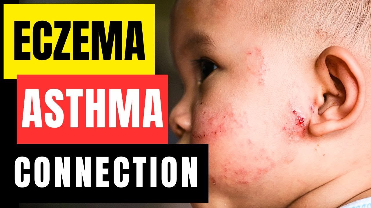 Взаимосвязь между экземой и астмой, объясненная врачом-специалистом.