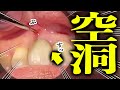 地球の裏側には大空洞がある　歯ぐきの中にも大空洞があんねん　信じるか信じないかはアナタ次第やねん　　ミセス都市伝説　歯医者カオリバーグ　やねん