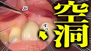 地球の裏側には大空洞がある　歯ぐきの中にも大空洞があんねん　信じるか信じないかはアナタ次第やねん　　ミセス都市伝説　歯医者カオリバーグ　やねん