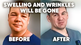 He permanently removed the swelling on his face and wrinkles and became so beautiful.
