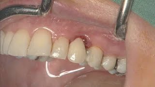 NobelActive clinical case: immediate implant placement  Eric Rompen