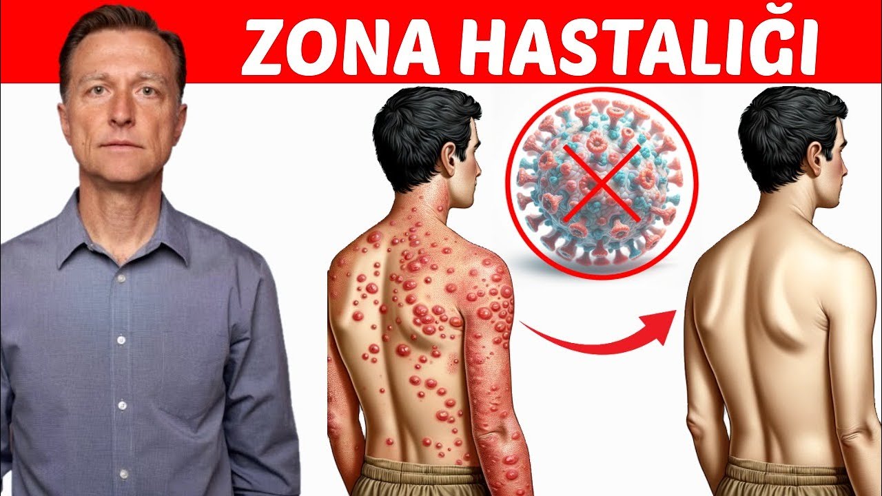 Zona Hastalığına Son: Bir Daha Asla Zona Olmayın | Dr.Berg Türkçe - YouTube