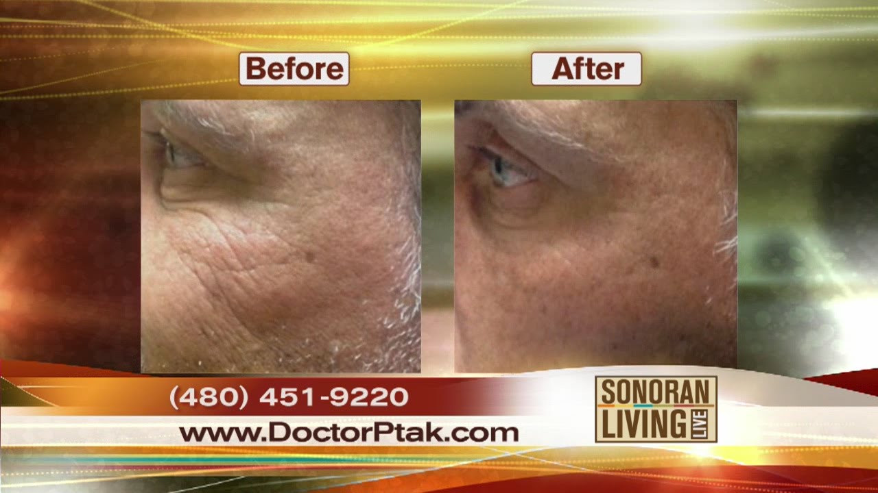 Thermi RF: Dr. Ptak details new procedure to smooth skin