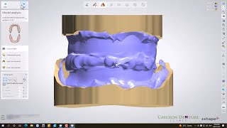 Denture Design with Gnathometer CAD