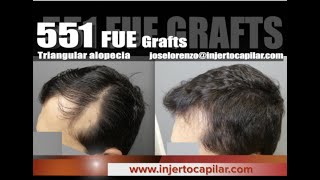 551FUE Grafts. Alopecia triangular congénita. Injertocapilar.com. 2557/2020