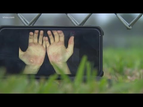 Coach on leave after exercise causes blisters on students' hands 