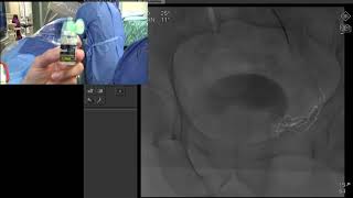 Transradial Prostate Artery Embolization for Benign Prostatic Hyperplasia (BPH)