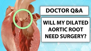 Doctor Q&A: The Progression and Surgery of Dilated Aortic Root Aneurysms with Dr. Luis Castro
