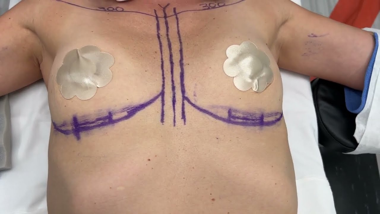 Going From a B to a C Cup with Implants! #breastaugmentation 