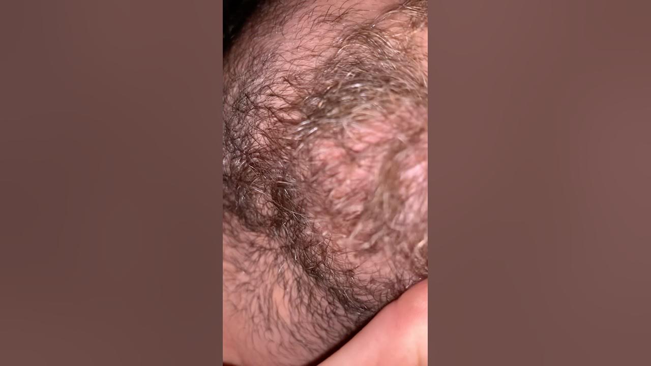 hair splinters are real things and can get infected #youtubeshorts #shorts hair splinters are real things and can get infected #youtubeshorts #shorts
