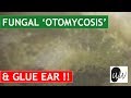 MOST CHALLENGING Otomycosis Fungal Ear Infection Removal from Ear with Glue Ear - #370