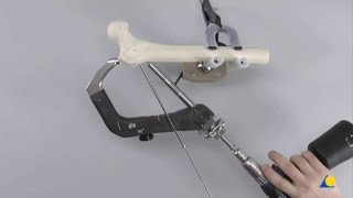 Intramedullary Fixation using the Advanced Proximal Femoral Nailing System TFNA screenshot 5