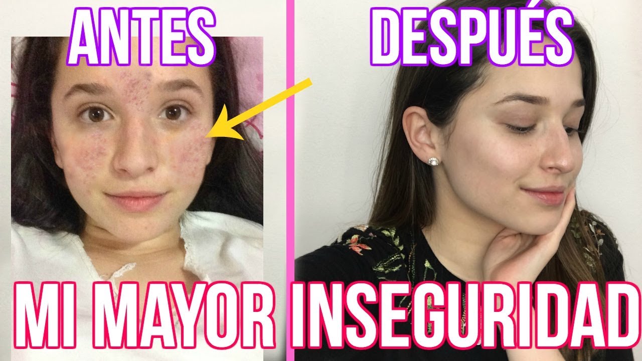 MI EXPERIENCIA CON EL ACNÉ : CÓMO ME CURÉ #STORYTIME | LAURA MEJIA