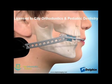 Cervical Headgear | City Orthodontics & Pediatric Dentistry Edmonton