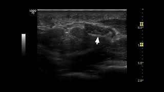 Ultrasound Detection of Carpal Tunnel Syndrome: Importance of Outlet Enlargement screenshot 3