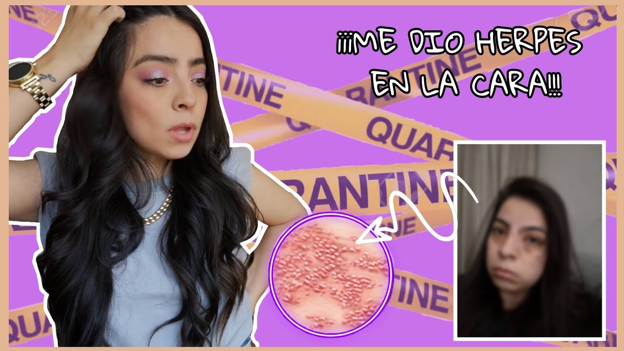 Mi experiencia con HERPES ZÓSTER en la CARA| Problemas dermatológicos