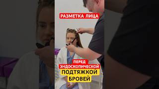 Эндоскопическая подтяжка бровей. Разметка лица перед операцией