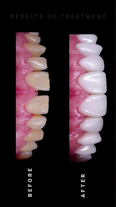 smile transformation ☺️ 😊 before and after #shorts #short #shortvideo