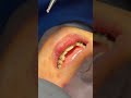 Amazing fix brace #shorts #teeth
