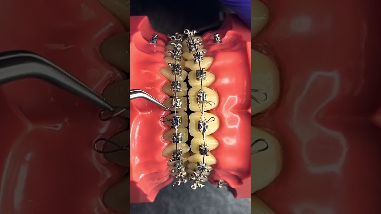 24/02/2025 - Dica 55  Fechamento  da mordida aberta anterior com Kobayashi e elástico em “box”